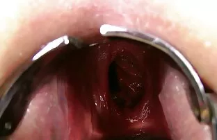 Prolapse রাশিয়ান